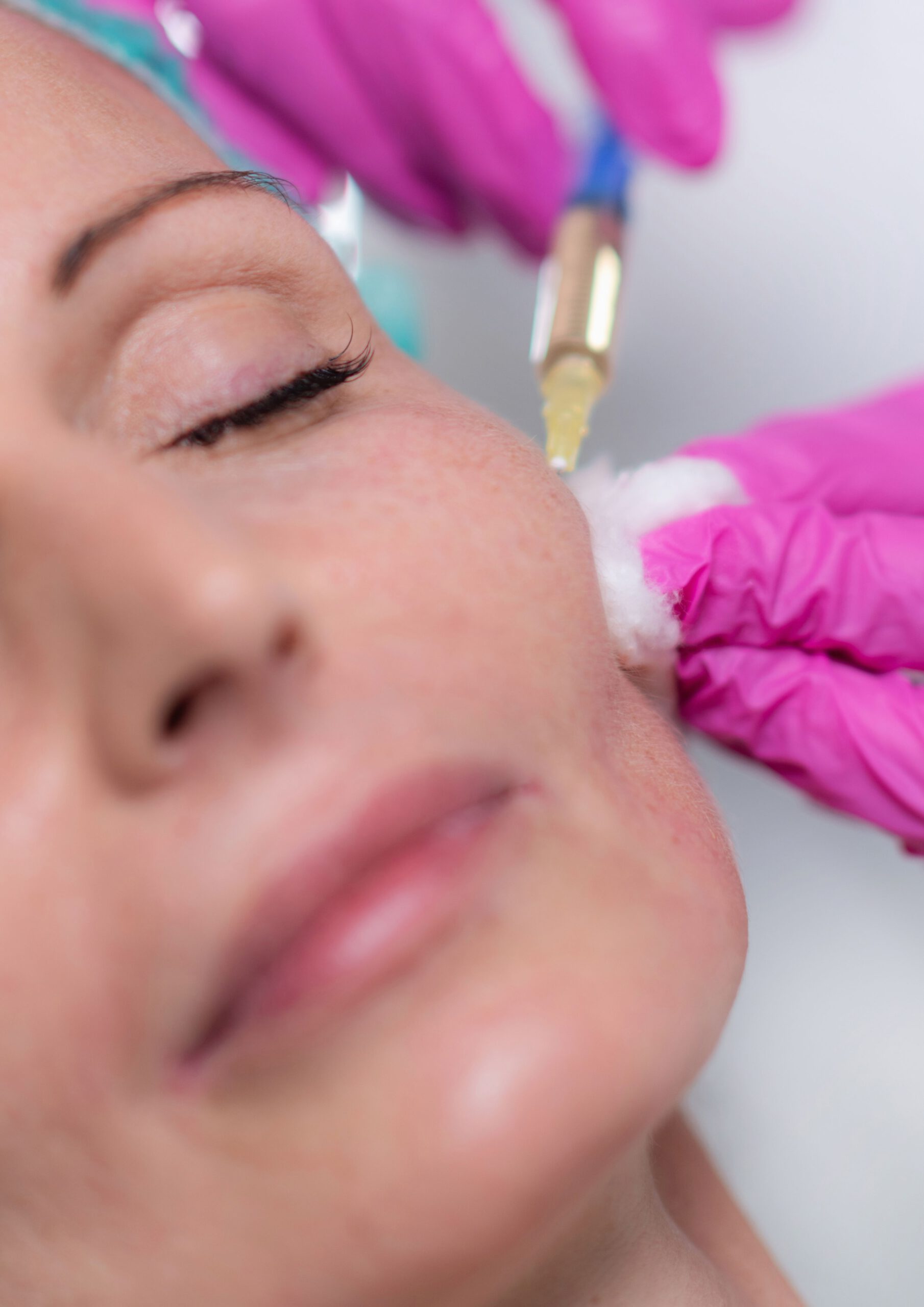 Ein weibliches Gesicht während einer Unterspritzung mit Hyaluronsäure